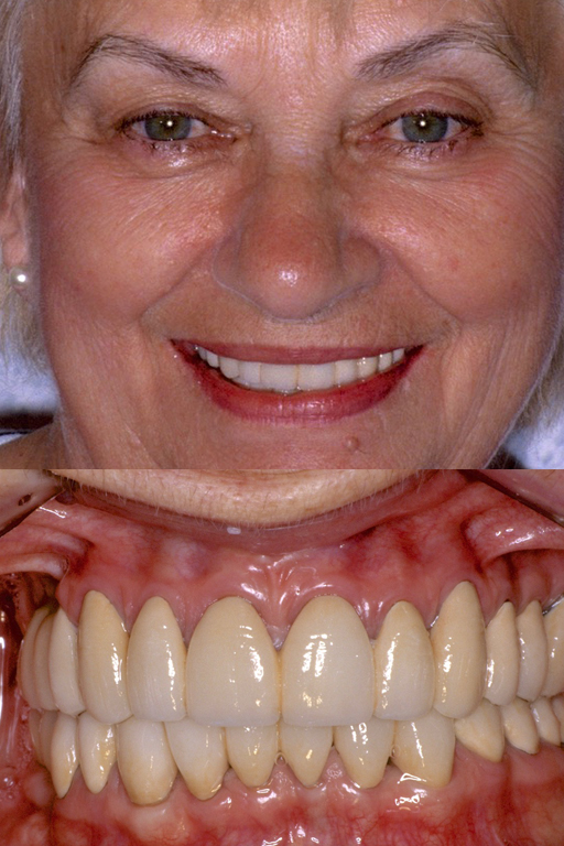 Full-mouth reconstruction after image 