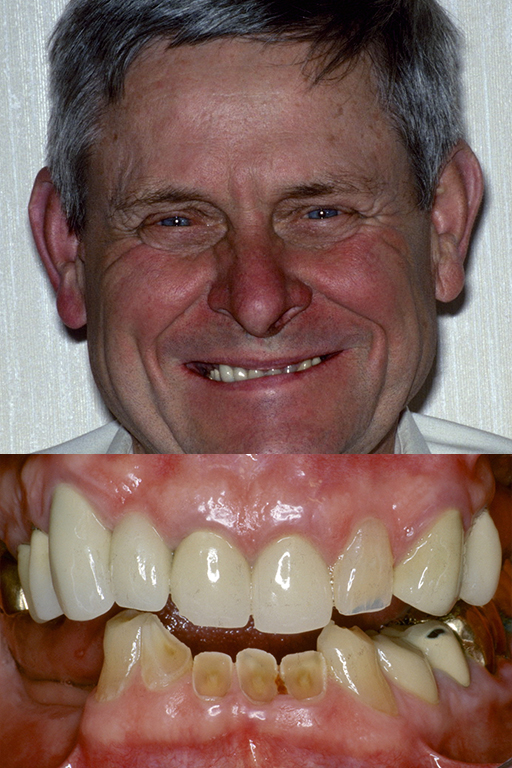 Full-mouth reconstruction before image 