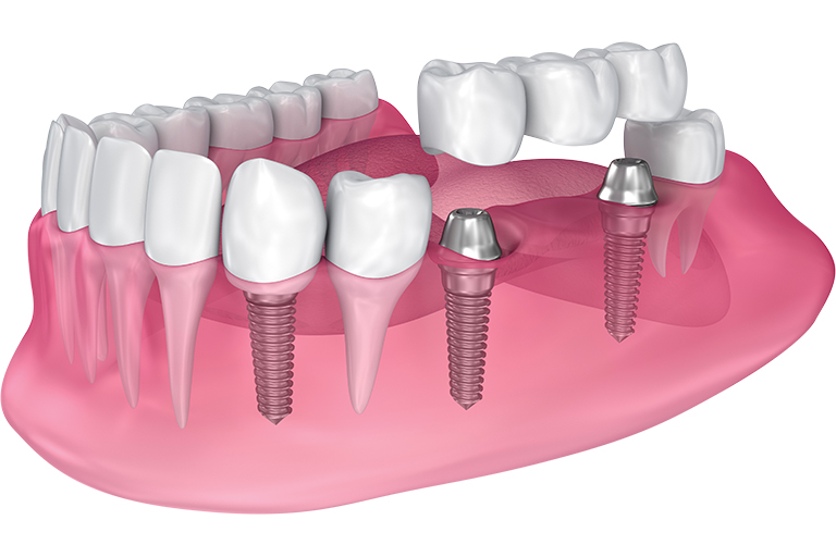 dental implants illustration