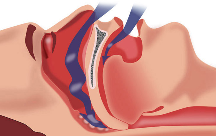 Oral appliance therapy for sleep apnea illustration