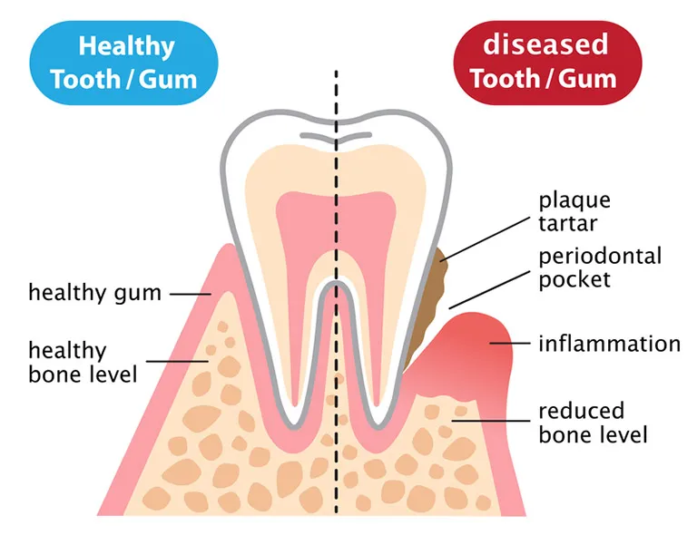 Diagram of how gum disease infects the gum tissue and leads to tooth decay and loss.