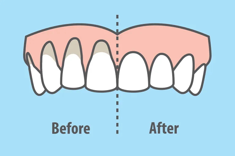 Diagram showing a before and after of gum recession treatment.