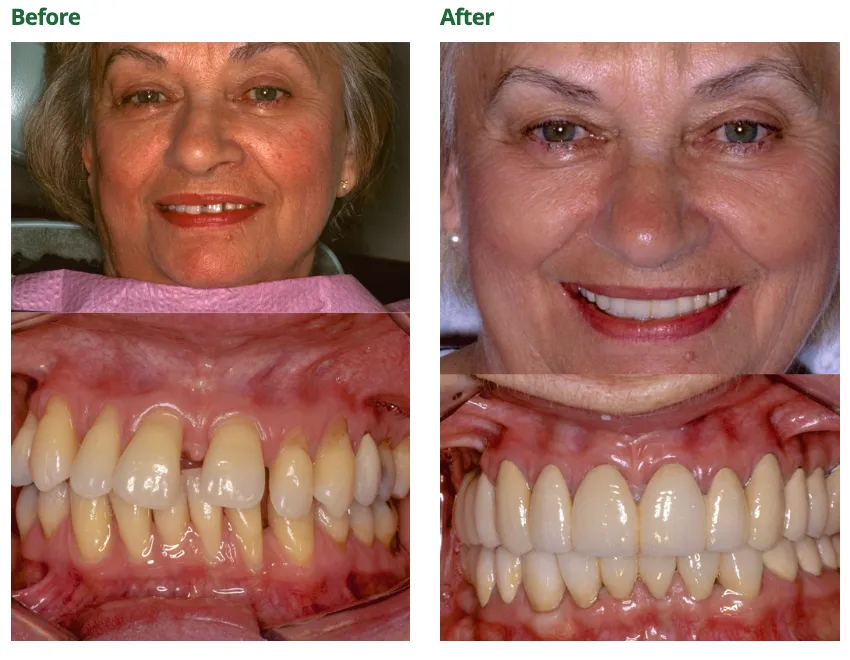 Before and after image of a patient who received full mouth reconstructive dentistry.