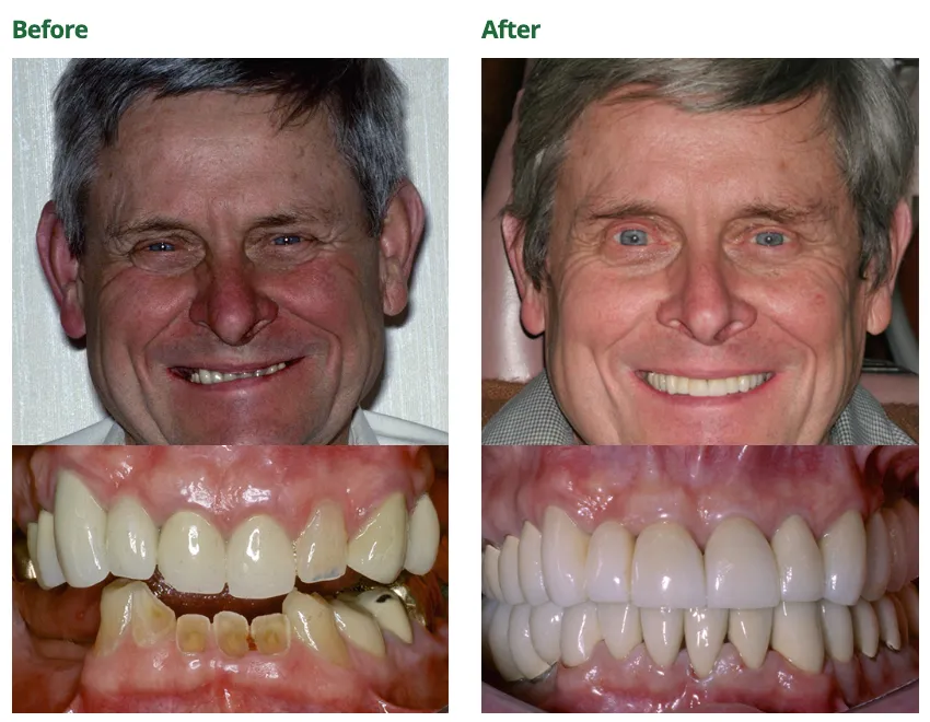 Before and after image of a patient who received full mouth reconstructive dentistry.