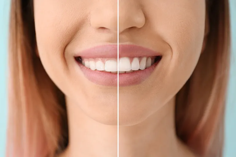 Before and after gum recontouring.