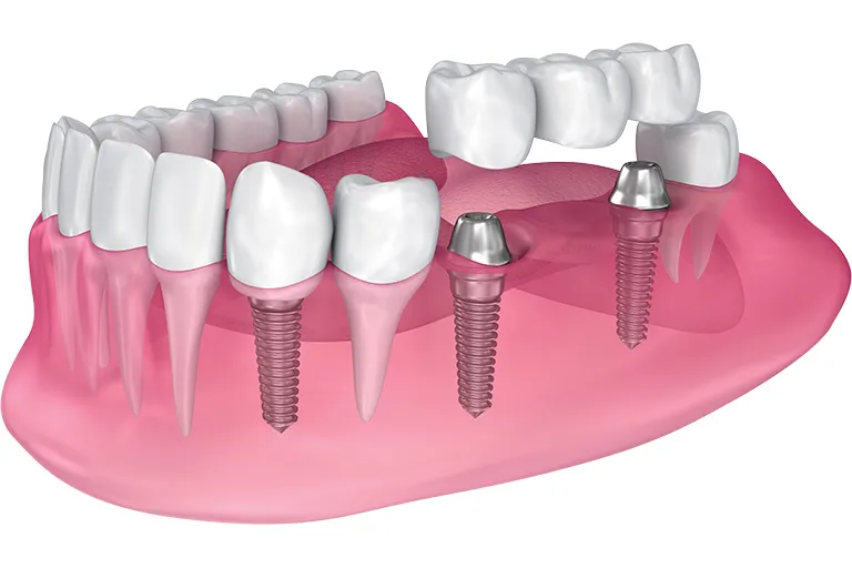 Implant bridge diagram.