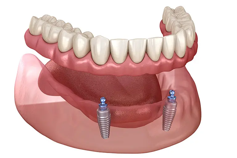 Image of dentures secured to the jawbone with two dental implants.