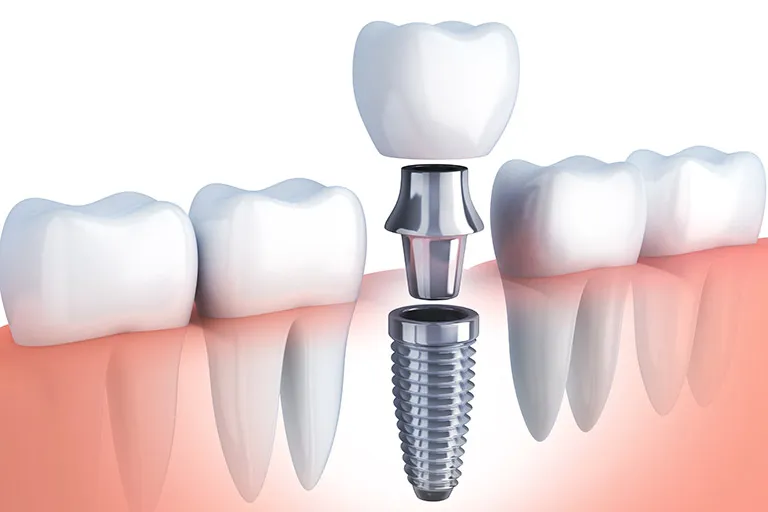 Diagram of a dental implant being inserted into the jawbone.