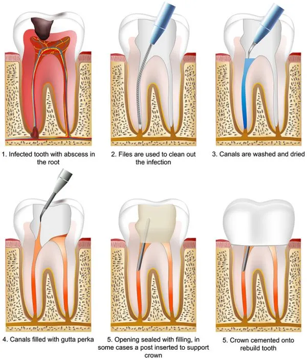 Diagram explaining the steps to a root canal.