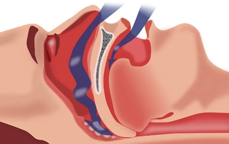 Oral appliance therapy for sleep apnea illustration.