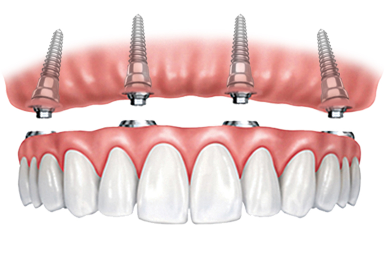 Implant-Supported Full-Arch bridges illustration