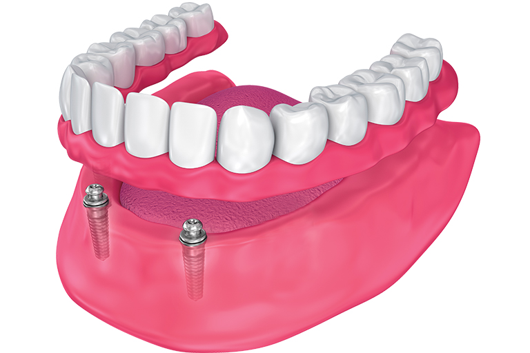 Implant supported snap-on dentures illustration